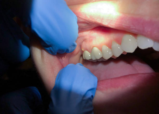 Best Emergency Dental Care for Broken or Chipped Teeth in Harlan, IN
